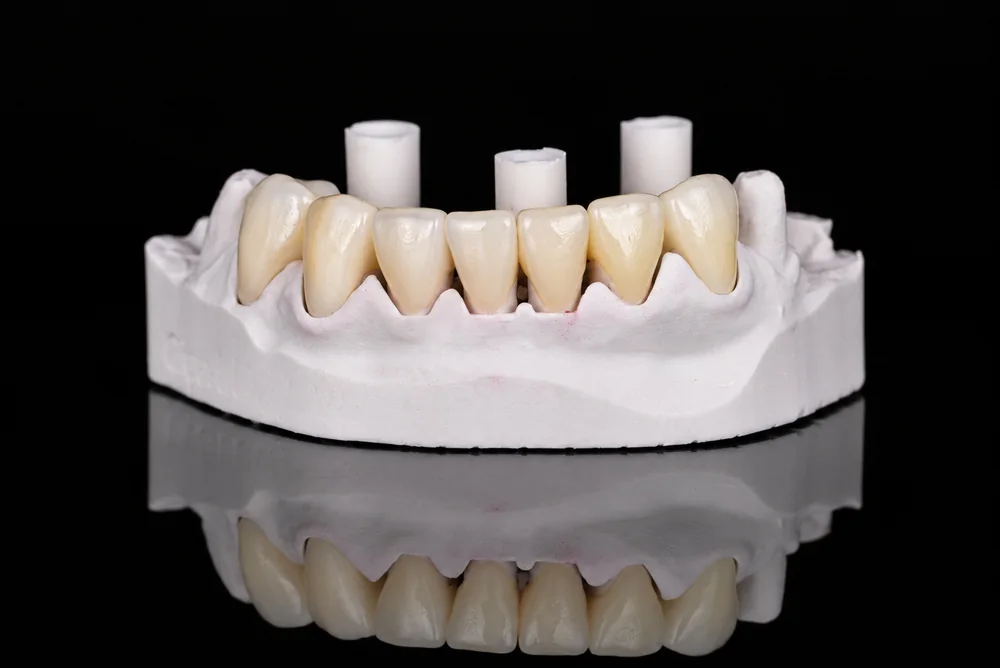 Crowns on a Model · Frontal View