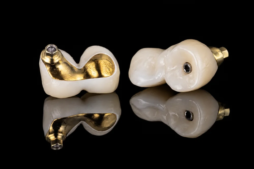 Screw-Retained Restorations · Close-Up